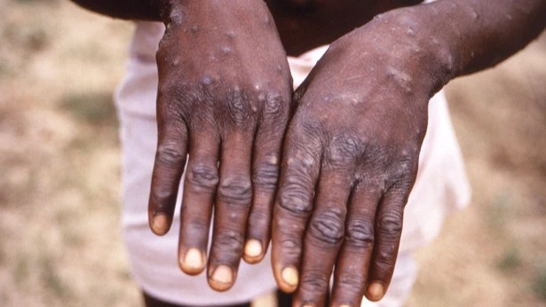 WHO declares Mpox no longer an international health emergency